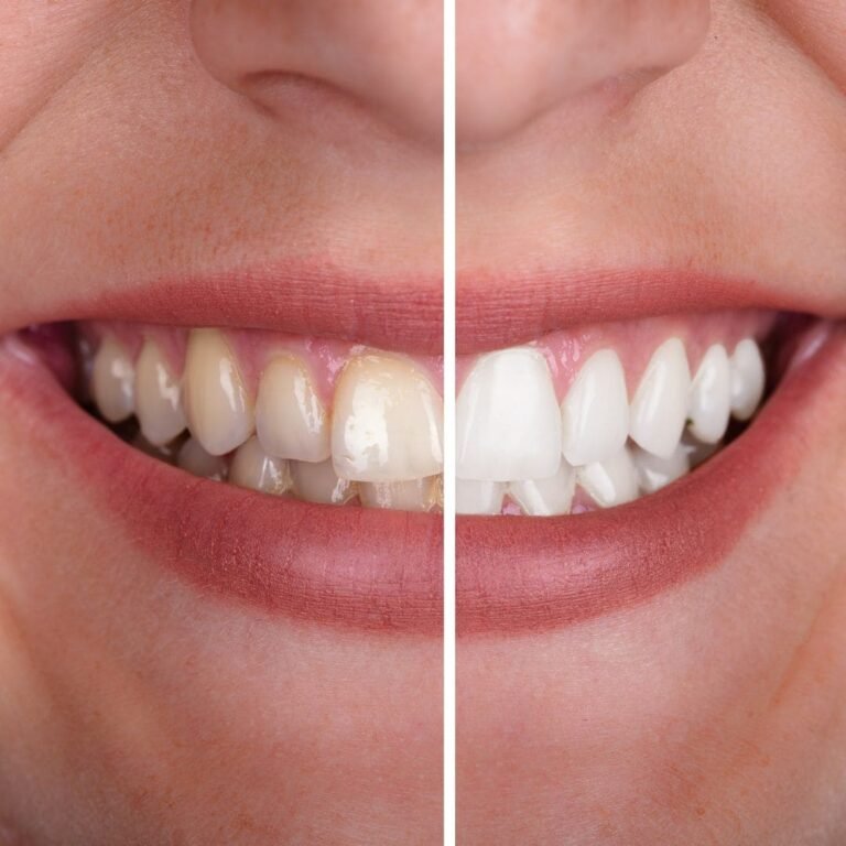 Before After Teeth