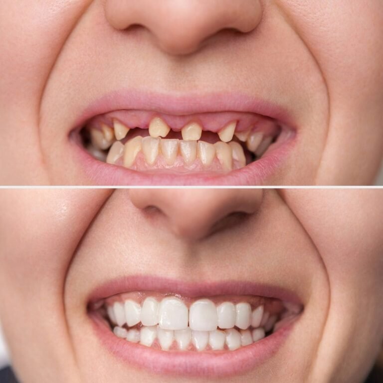 Before After Teeth